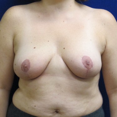 Breast Reduction- After