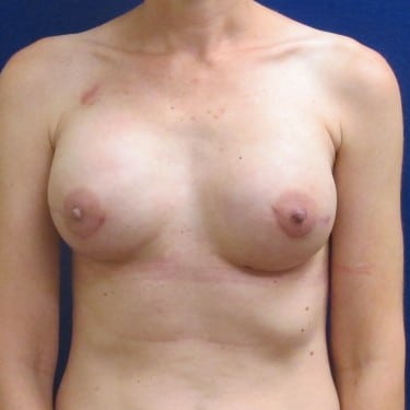 Breast Reconstruction- After