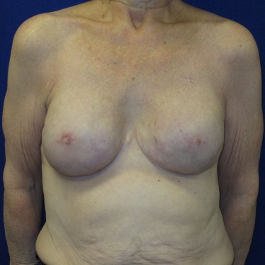 Breast Reconstruction- After