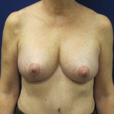 Breast Revision - After