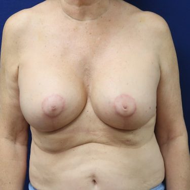 Breast Augmentation with Lift - After