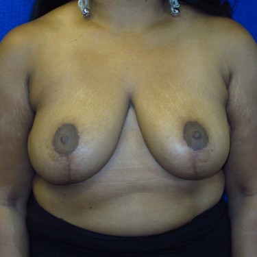 Breast Reduction- After