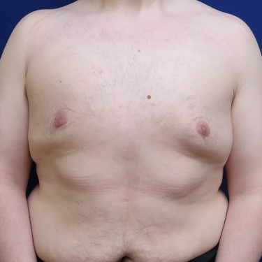 Male Breast Reduction - After