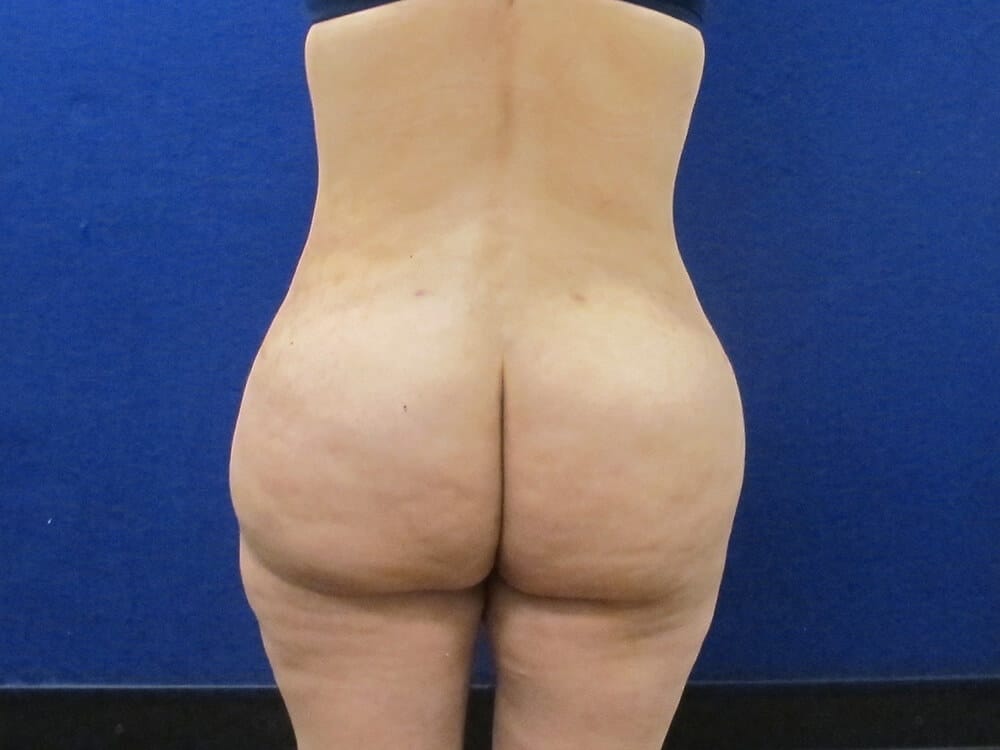 Case--7829 | After Fat Grafting