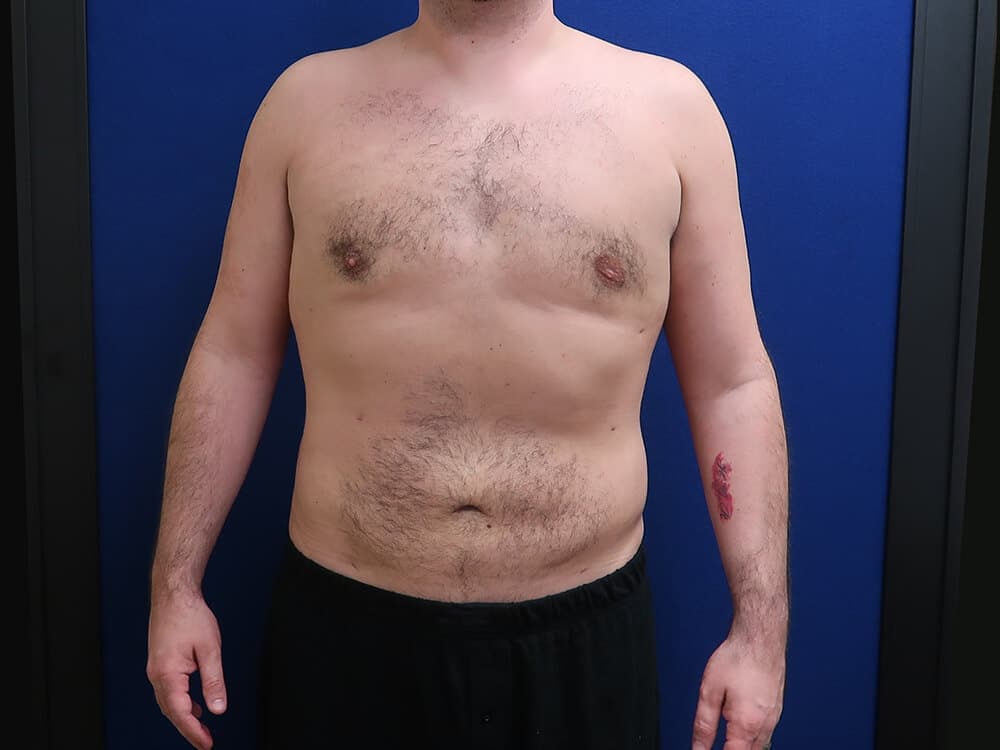 After Male Breast Reduction Gynecomastia