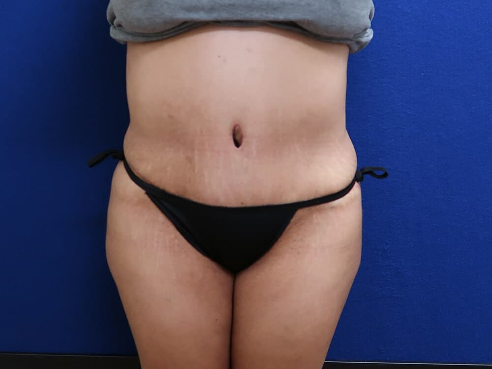 Case--4412 | After Tummy Tuck