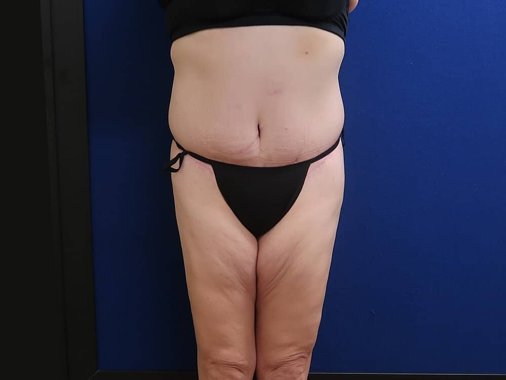 Case--7495 | After Lower Body Lift