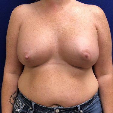 Breast Augmentation - After
