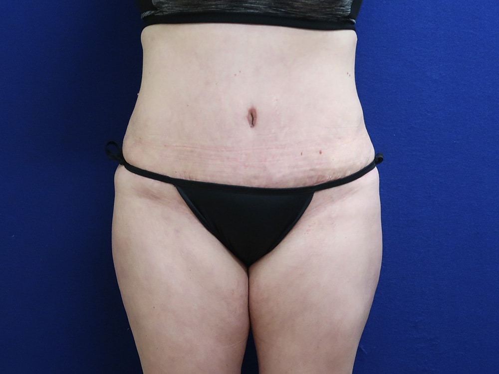 Case--9340 | After Tummy Tuck