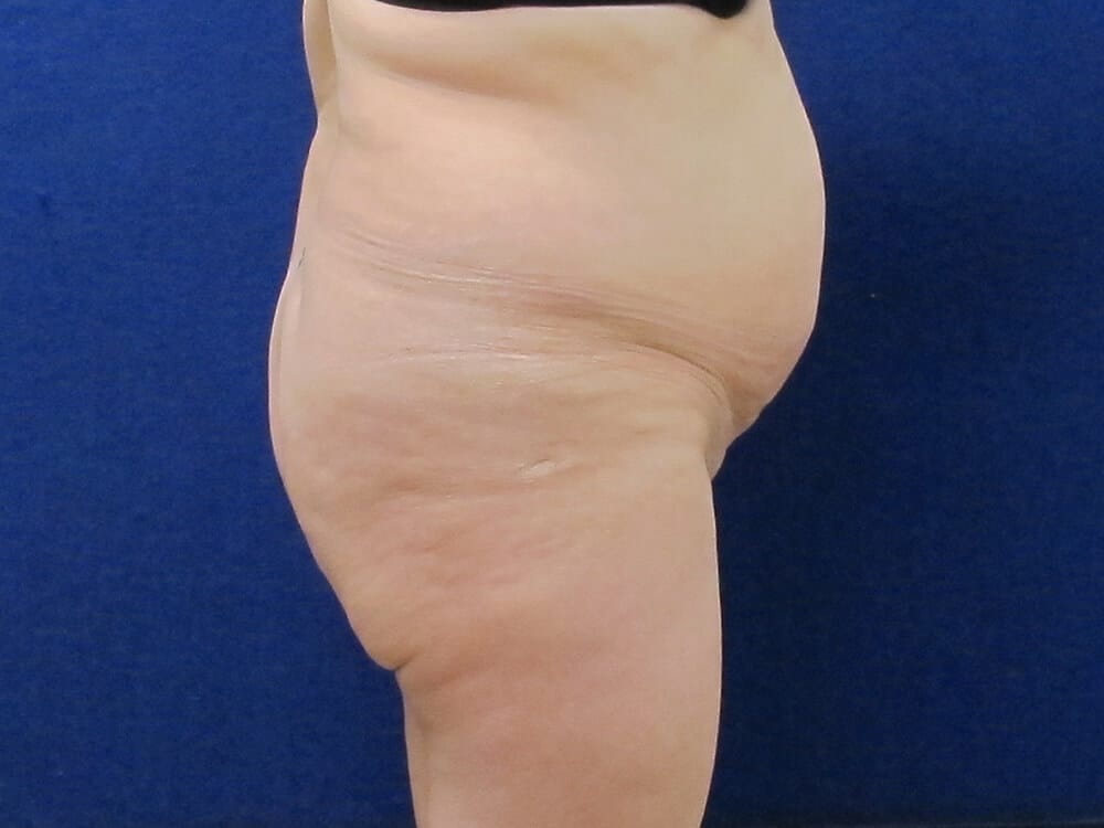 Case--4989 | Before Brazilian Buttock Lift