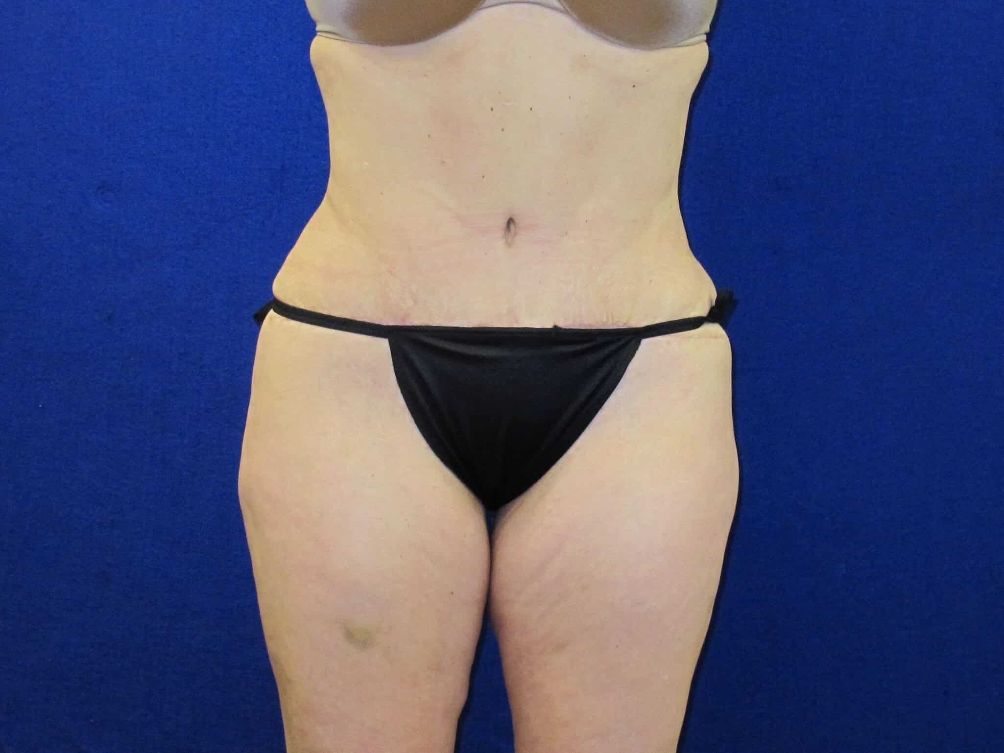 Case--4293 | After Tummy Tuck