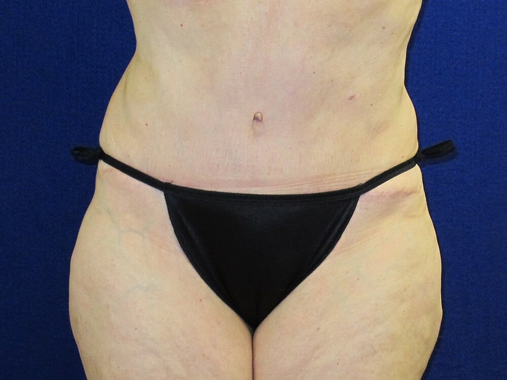 Case--7812 | After Tummy Tuck