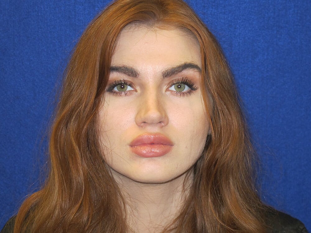 Case--7286 | After Injectables