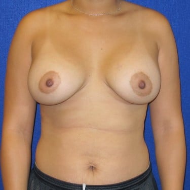 Breast Augmentation - After