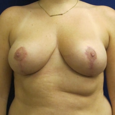 Breast Reduction- After