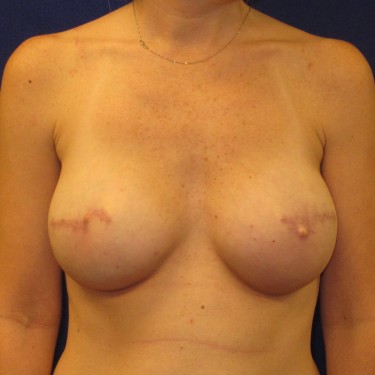 Breast Reconstruction- After