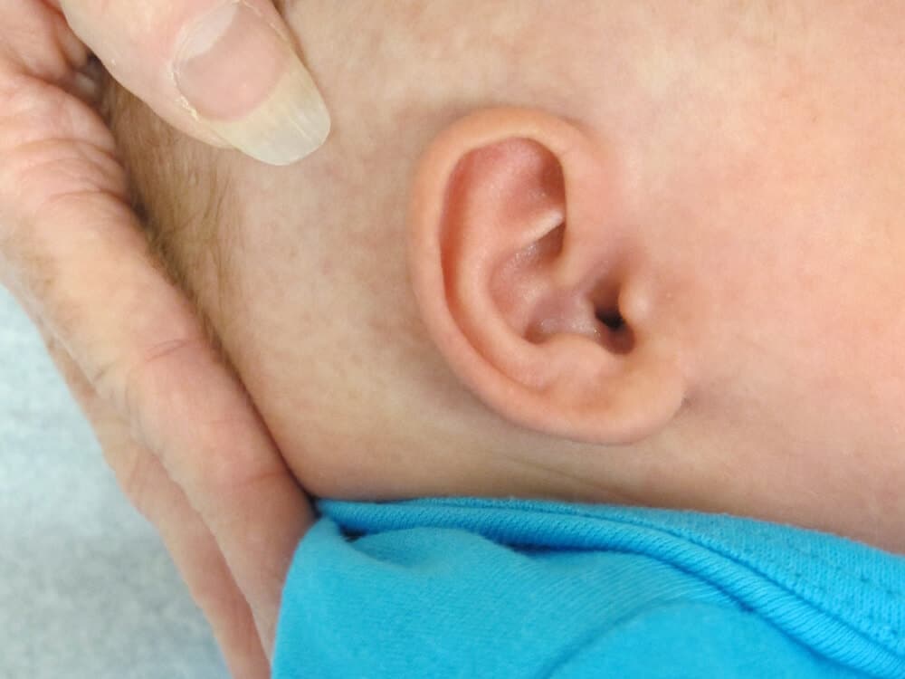 Case--1249 | After EarWell™