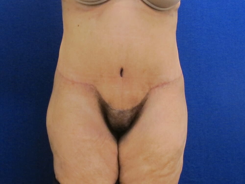 Case--7758 | After Body