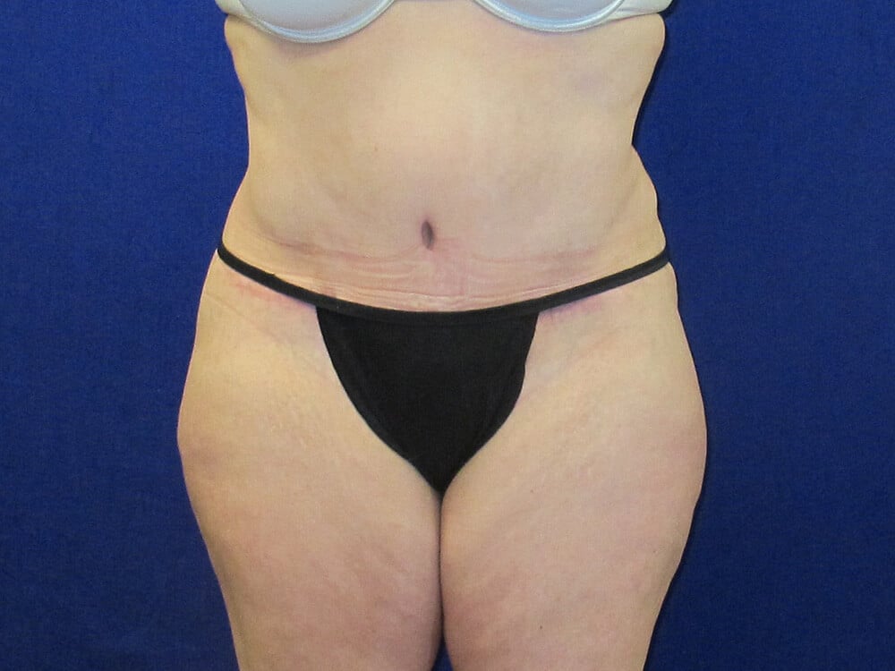 Case--7369 | After Tummy Tuck
