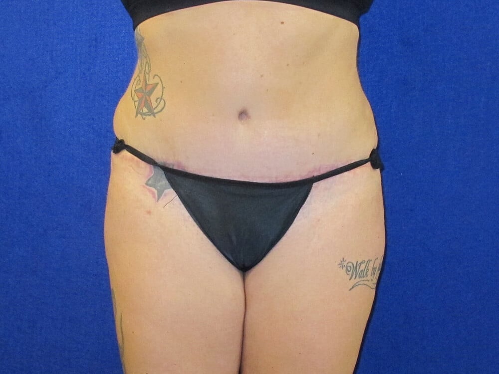 Case--3214 | After Tummy Tuck