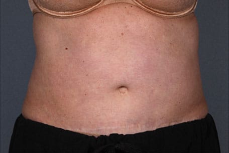 Case--1437 | After Liposonix