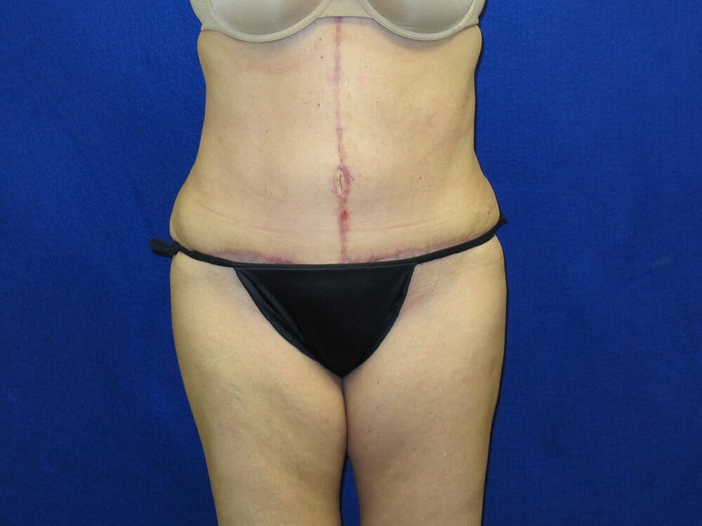 Case--2719 | After Tummy Tuck
