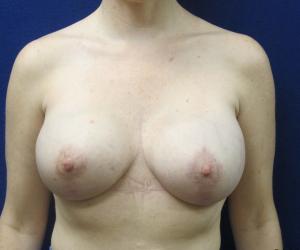 Breast Augmentation with Lift - After