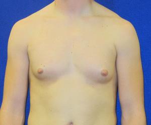 Case--3238 | Before Liposuction