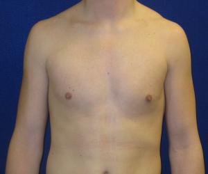 Case--3238 | After Liposuction