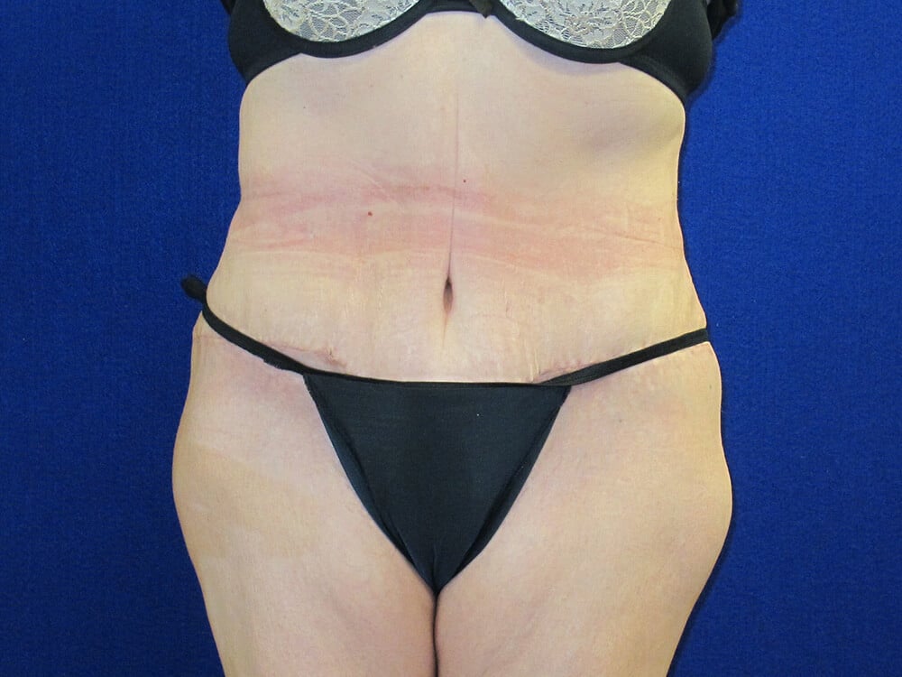 Case--6254 | After Tummy Tuck