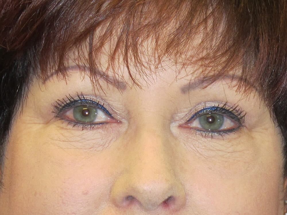 Case--8530 | After Blepharoplasty