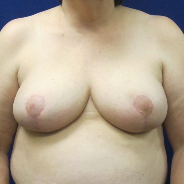 Breast Reduction- After