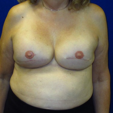 Breast Reconstruction- After