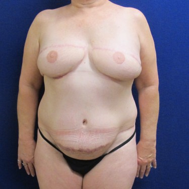 Breast Reconstruction- After