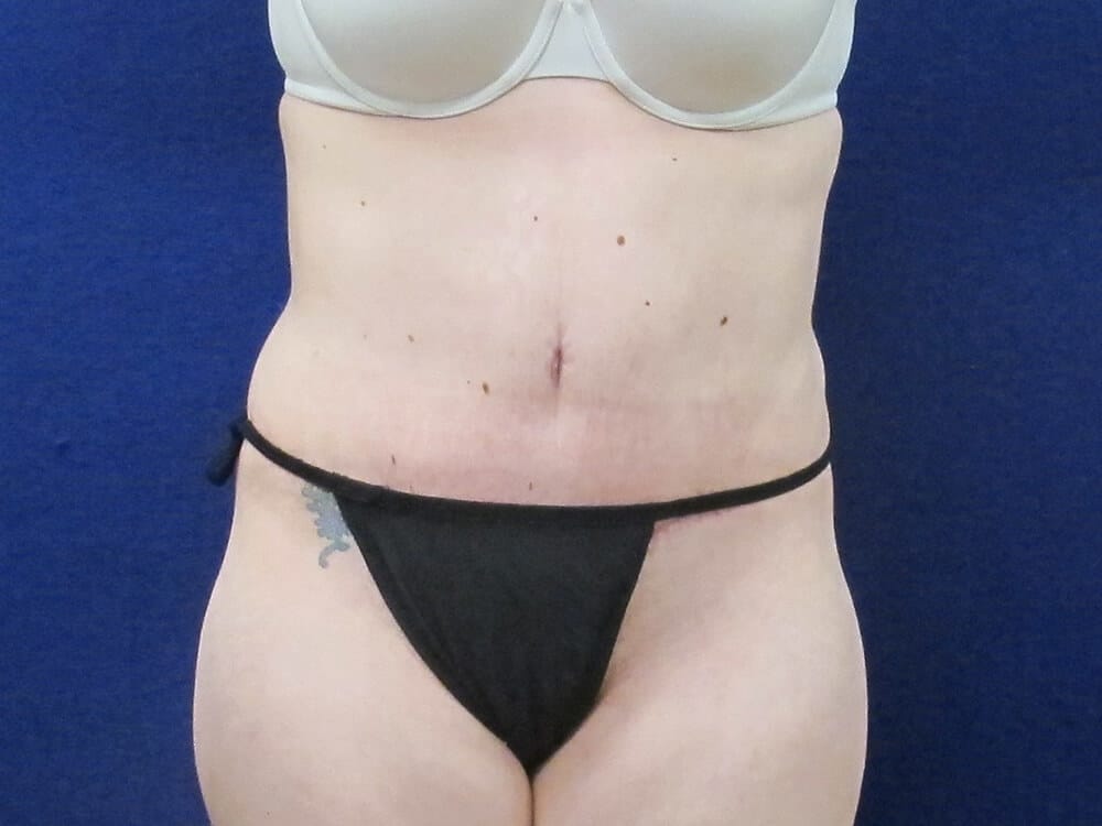 Case--7740 | After Tummy Tuck