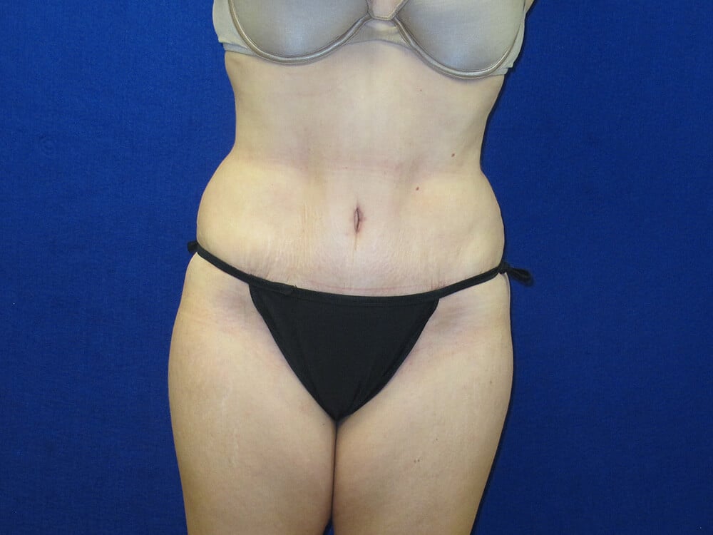 Case--6928 | After Tummy Tuck