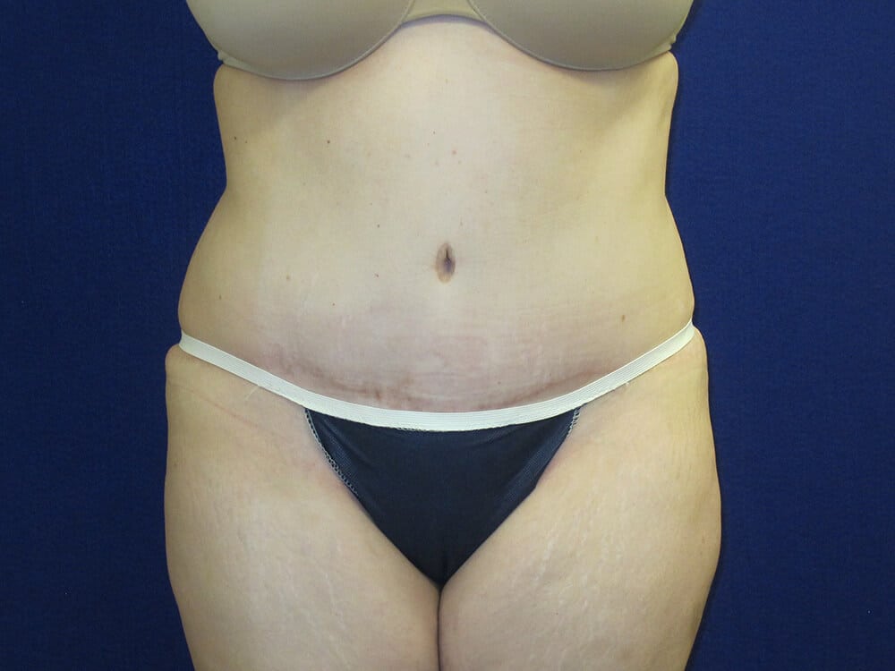 Case--9283 | After Tummy Tuck