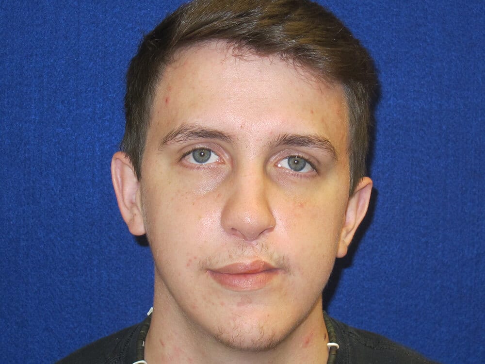 Case--1794 | After Face