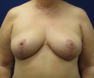 Breast Lift - After