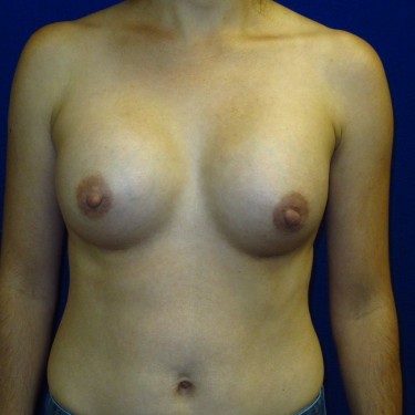 Breast Augmentation - After
