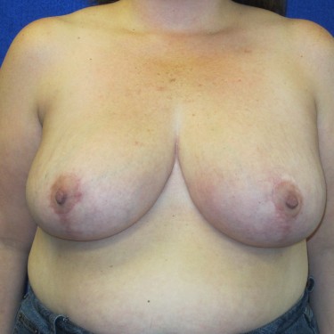 Breast Reduction- After
