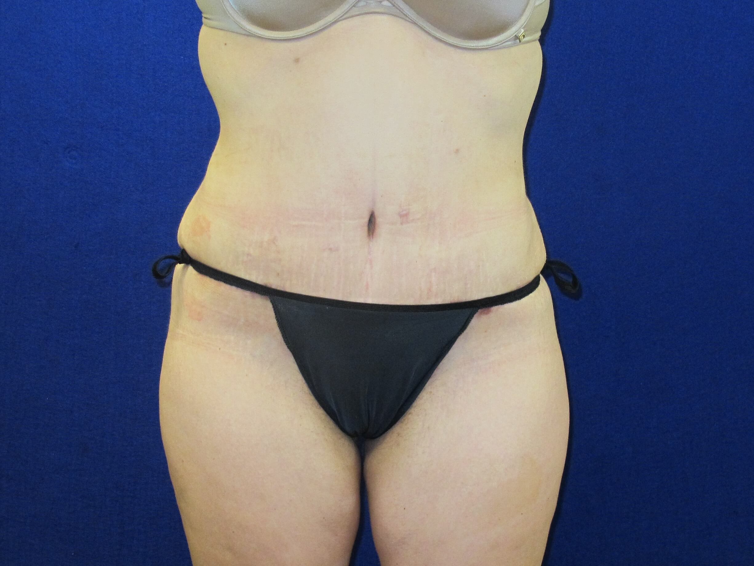 Case--7026 | After Tummy Tuck