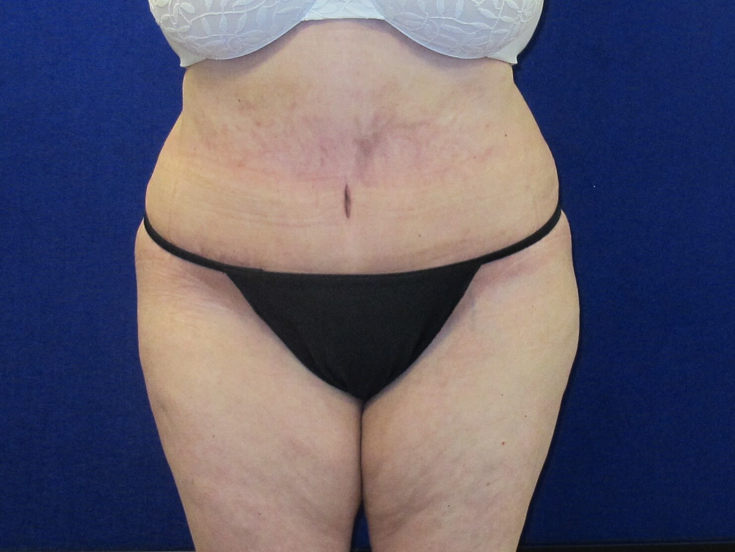 Case--1749 | After Tummy Tuck