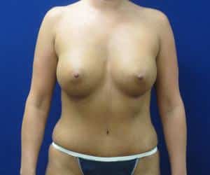 Case--9270 | After Mommy Makeover