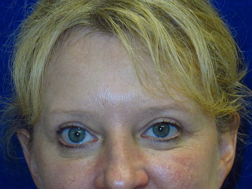 Case--2641 | After Blepharoplasty