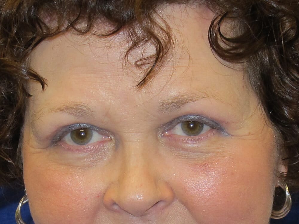 Case--6624 | After Brow Lift