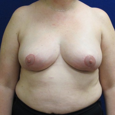 Breast Reduction- After