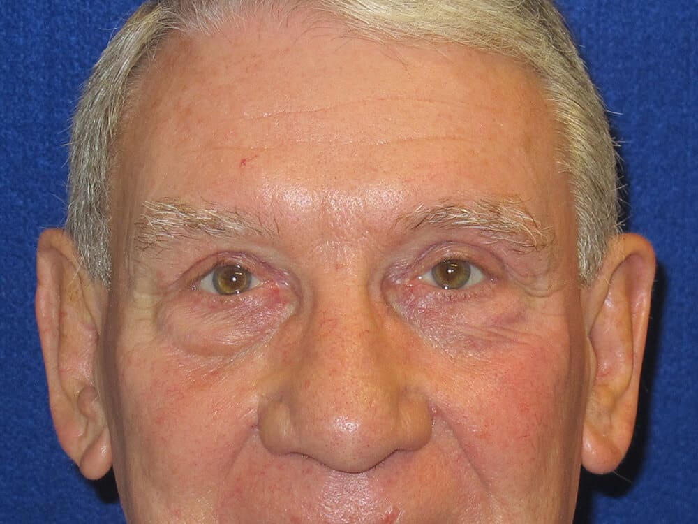 Case--1679 | After Blepharoplasty