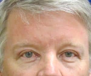 Case--6848 | After Brow Lift