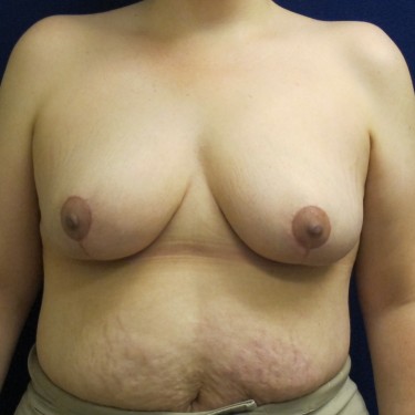Breast Reduction- After